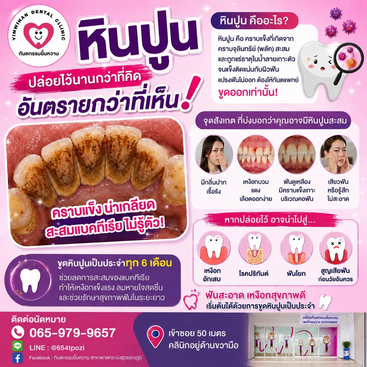 โปรโมชันเด็ด! ขูดหินปูน 1,111 บาท ฟรีขัดฟัน เคลือบฟลูออไรด์