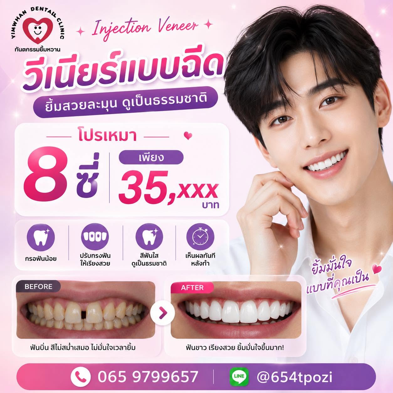 วีเนียร์ (Veneer) เปลี่ยนรอยยิ้มพังให้ปังในพริบตา
