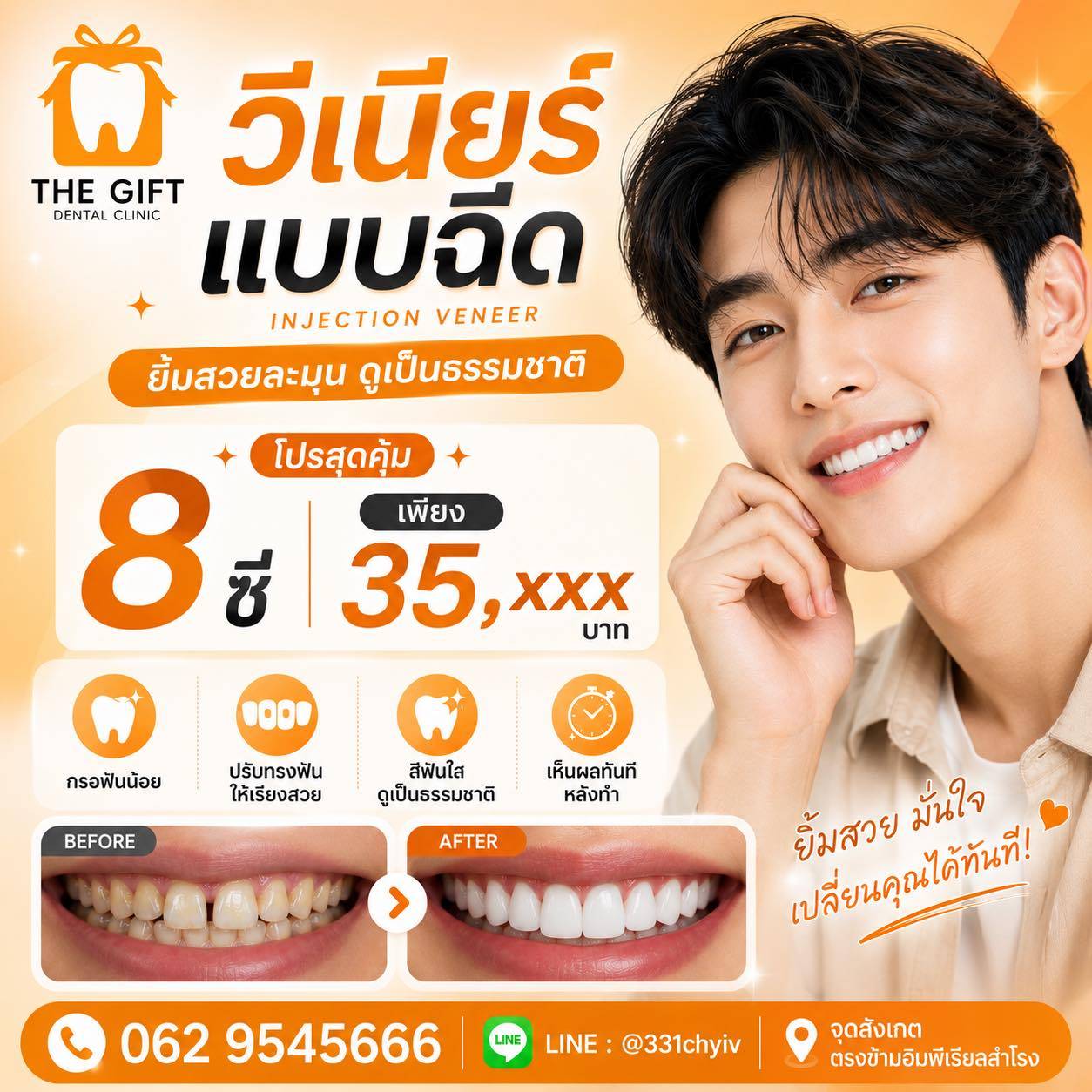 เคสวีเนียร์เซรามิก 8 ซี่หน้าบน